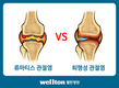 ‘류마티스관절염’과 ‘퇴행성관절염’어떻게 다를까?